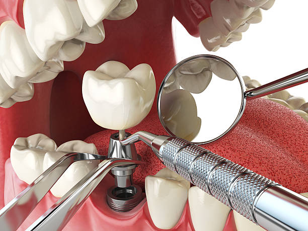 Best Emergency Dental Care for Broken or Chipped Teeth in , WY